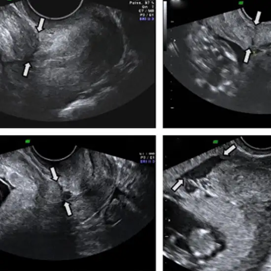 ultrasound whole abdomen with tvs scan